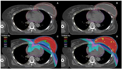 A Retrospective Dosimetric Analysis of the New ESTRO-ACROP Target Volume Delineation Guidelines for Postmastectomy Volumetric Modulated Arc Therapy After Implant-Based Immediate Breast Reconstruction
